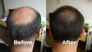 male-pattern baldness